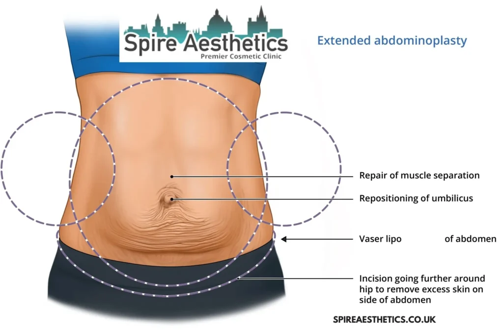 Understanding Loose Skin After Gastric Band Shoreham by Sea Surgery and HIFU Treatment