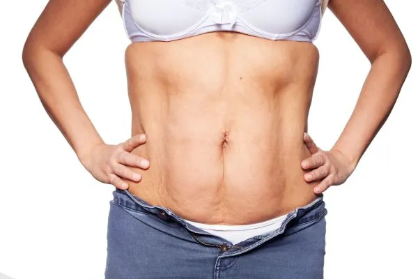 sagging skin on woman's stomach after weight loss injections Shoreham by Sea