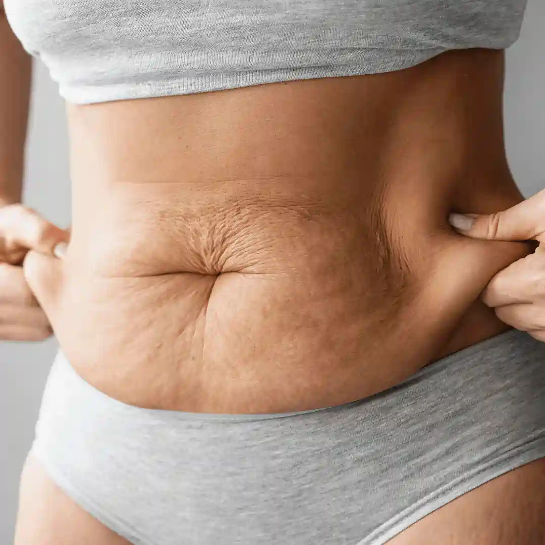 Is It Normal to Have Loose Skin After Pregnancy Shoreham by Sea?